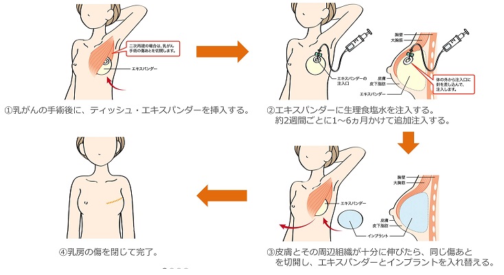 乳がんとは 医療法人豊仁会三井病院